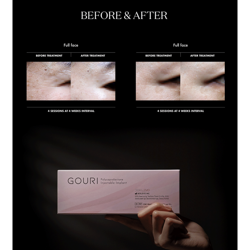 Gouri PCL (Polycaprolactone) Implant