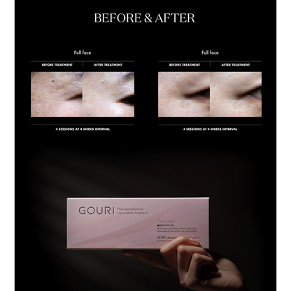 Gouri PCL (Polycaprolactone) Implant